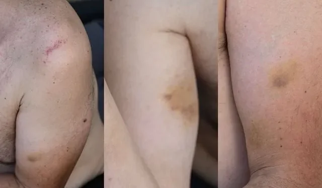 Μύκονος: Αστυνομικοί ξυλοφόρτωσαν διαβητικό που προσπαθούσε να κάνει ένεση ινσουλίνης