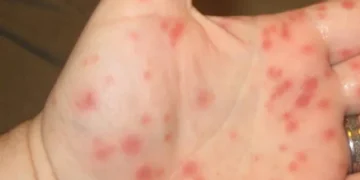 Στρεπτόκοκκος: Εμφανίστηκαν κρούσματα και σε σχολεία των Χανίων