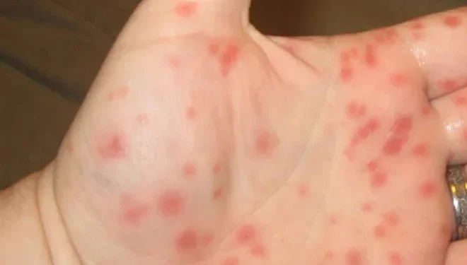 Στρεπτόκοκκος: Εμφανίστηκαν κρούσματα και σε σχολεία των Χανίων