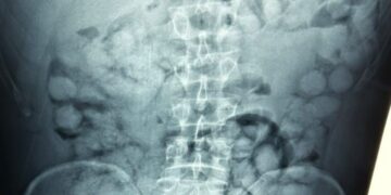 «Ελ. Βενιζέλος»: Συνελήφθη Βραζιλιάνος που κατάπιε 100 «αυγουλάκια» κοκαΐνης για να τα περάσει στην Ελλάδα