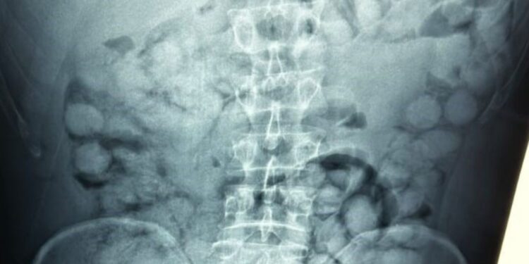 «Ελ. Βενιζέλος»: Συνελήφθη Βραζιλιάνος που κατάπιε 100 «αυγουλάκια» κοκαΐνης για να τα περάσει στην Ελλάδα