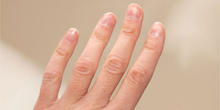 Τι πρέπει να προσέχεις για να έχεις υγιή νύχια