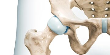 Τι είναι η τεχνική AMIS στην αρθροπλαστική ισχίου