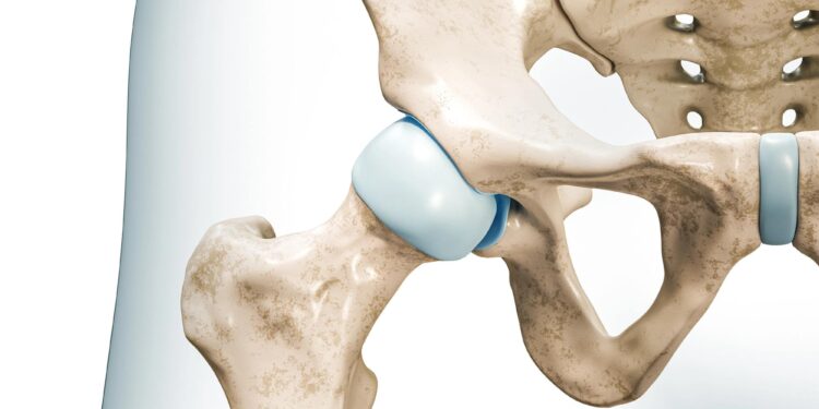 Τι είναι η τεχνική AMIS στην αρθροπλαστική ισχίου