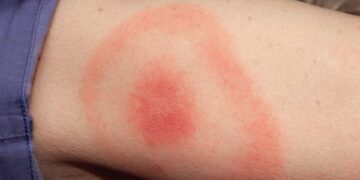 Νόσος Lyme: Συμπτώματα, διάγνωση και αντιμετώπιση