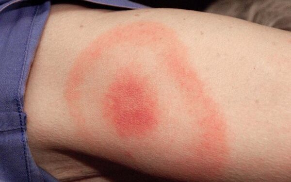 Νόσος Lyme: Συμπτώματα, διάγνωση και αντιμετώπιση