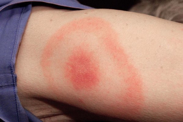 Νόσος Lyme: Συμπτώματα, διάγνωση και αντιμετώπιση