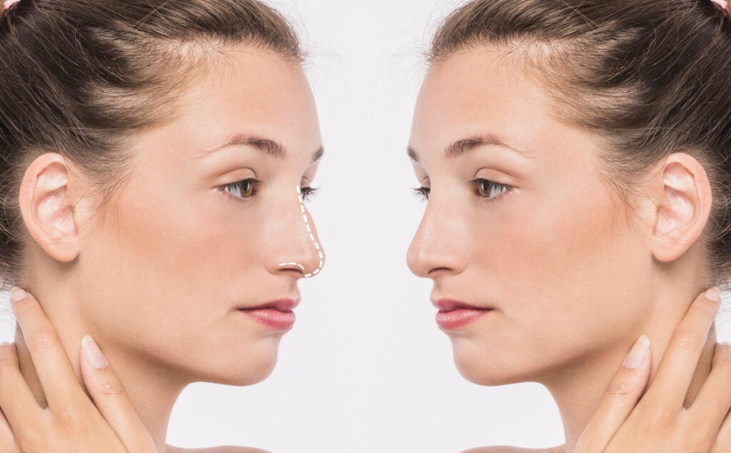 Αναδείξτε τη φυσική ομορφιά σας με Ρινοπλαστική