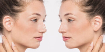 Αναδείξτε τη φυσική ομορφιά σας με Ρινοπλαστική