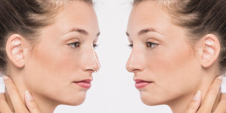 Αναδείξτε τη φυσική ομορφιά σας με Ρινοπλαστική