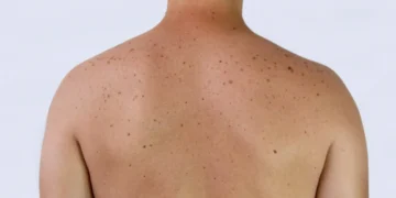 Πως να μειώσετε τον κίνδυνο εμφάνισης ηλιακών κηλίδων όταν βγαίνετε έξω