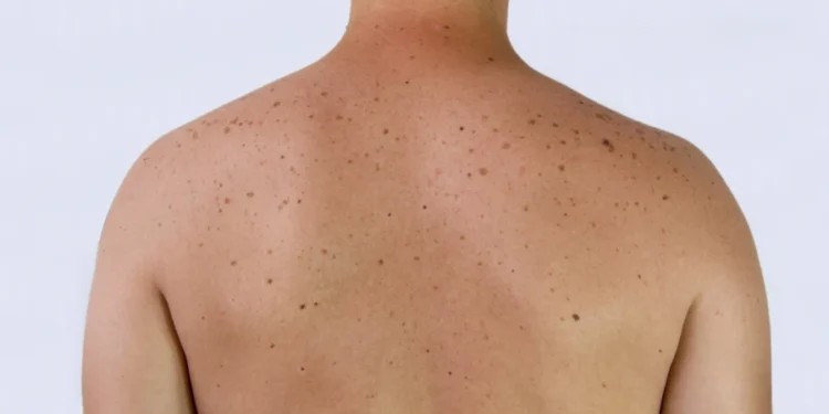 Πως να μειώσετε τον κίνδυνο εμφάνισης ηλιακών κηλίδων όταν βγαίνετε έξω