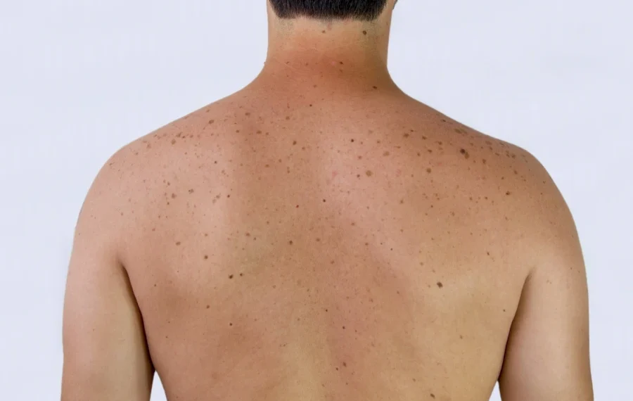 Πως να μειώσετε τον κίνδυνο εμφάνισης ηλιακών κηλίδων όταν βγαίνετε έξω