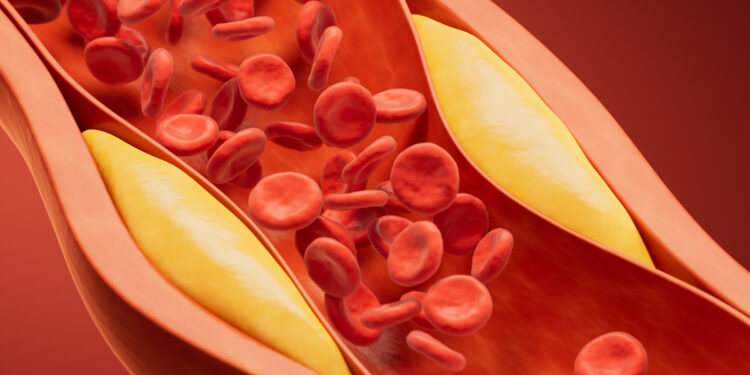 Νέα χαμηλότερα όρια για τη «κακή» χοληστερόλη - Τι πρέπει να γνωρίζουμε