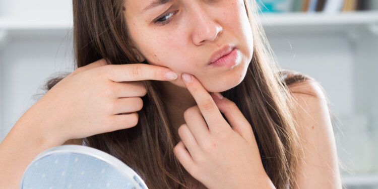 Ακμή ενηλίκων: γιατί εμφανίζεται μετά τα 30