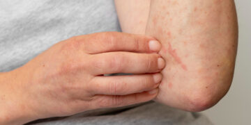 Κνίδωση: πότε πρέπει να ανησυχήσετε