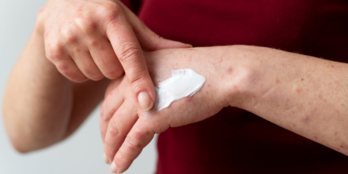 Δερματίτιδα εξ επαφής: αιτίες και αντιμετώπιση