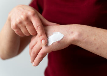 Δερματίτιδα εξ επαφής: αιτίες και αντιμετώπιση