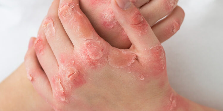 Ατοπική δερματίτιδα: πώς να την ελέγξετε