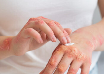 Μυκητιάσεις δέρματος: πώς μεταδίδονται