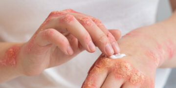 Μυκητιάσεις δέρματος: πώς μεταδίδονται