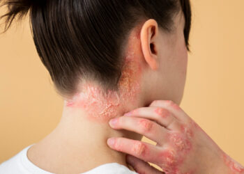 Ψωρίαση: μύθοι και αλήθειες