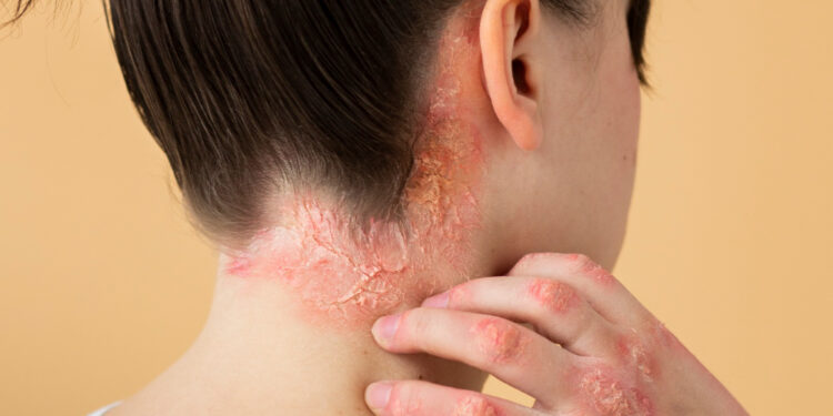 Ψωρίαση: μύθοι και αλήθειες