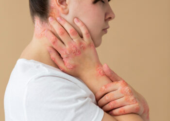 Ιογενείς λοιμώξεις δέρματος: βασικές πληροφορίες