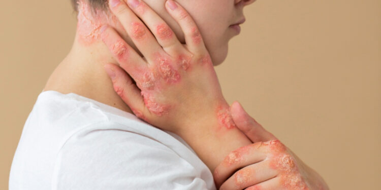 Ιογενείς λοιμώξεις δέρματος: βασικές πληροφορίες