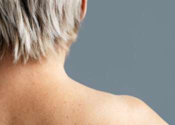 Μελάνωμα: πώς να το αναγνωρίσετε έγκαιρα