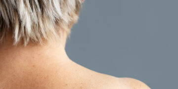 Μελάνωμα: πώς να το αναγνωρίσετε έγκαιρα