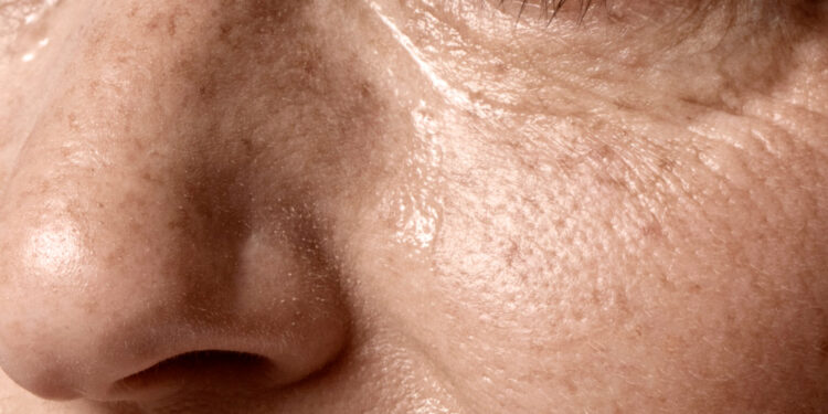 Φωτογήρανση: πώς προκαλείται