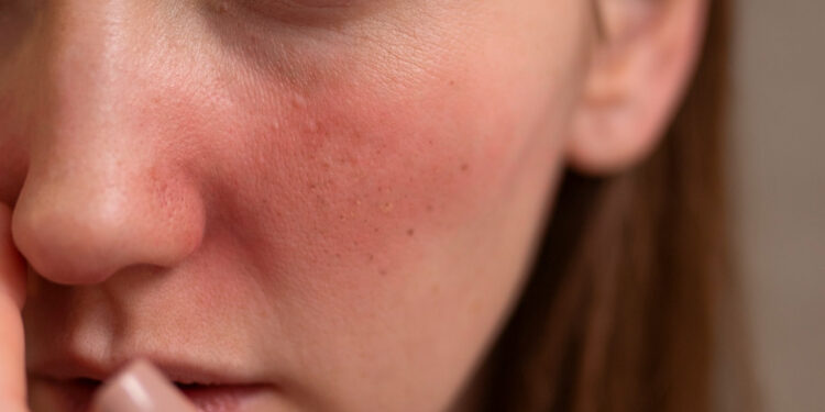 Ευαίσθητο δέρμα: πώς να το προστατεύσετε