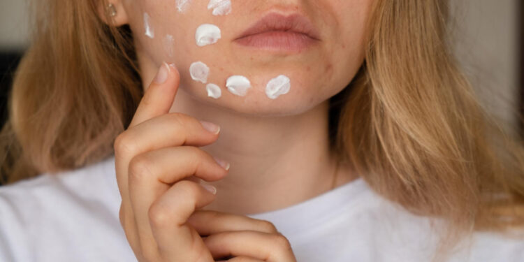 Τι είναι η ακμή και ποιοι παράγοντες την επιδεινώνουν