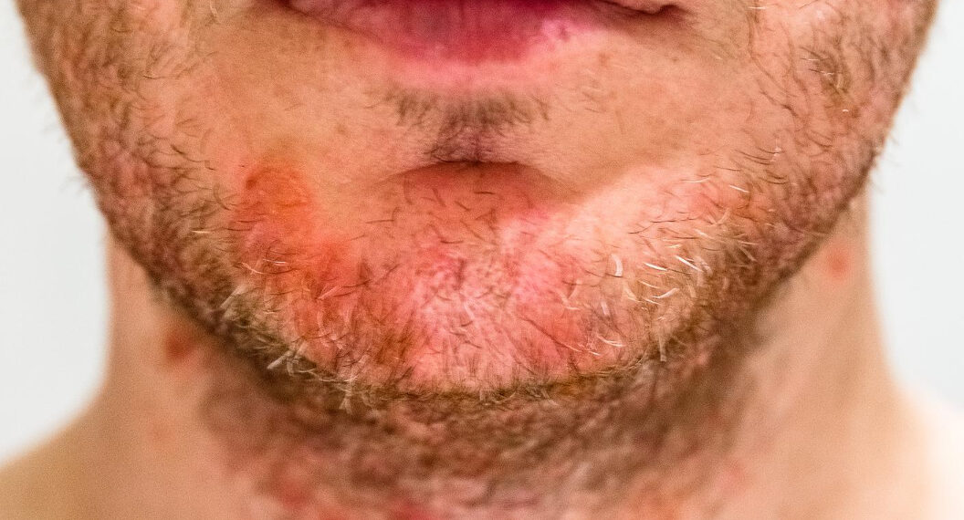 Σμηγματορροϊκή δερματίτιδα: τι πρέπει να γνωρίζετε