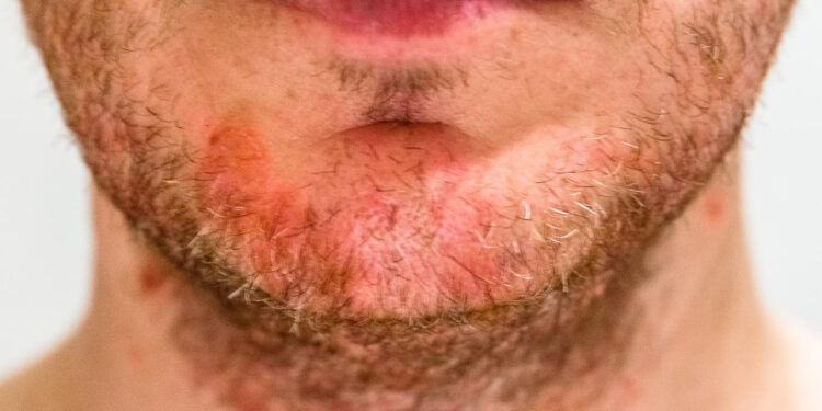 Σμηγματορροϊκή δερματίτιδα: τι πρέπει να γνωρίζετε