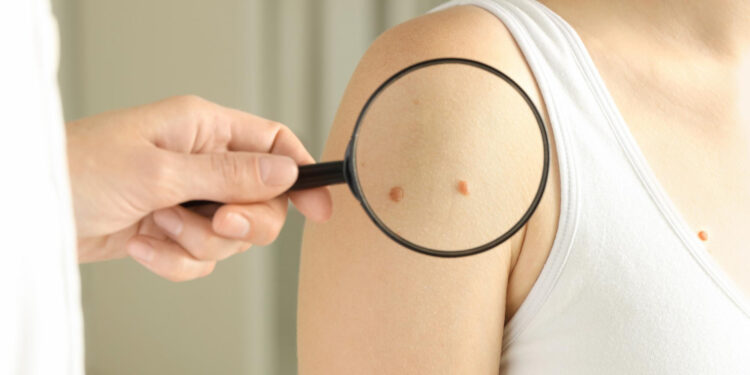 Καρκίνος του δέρματος: πρώιμα σημάδια