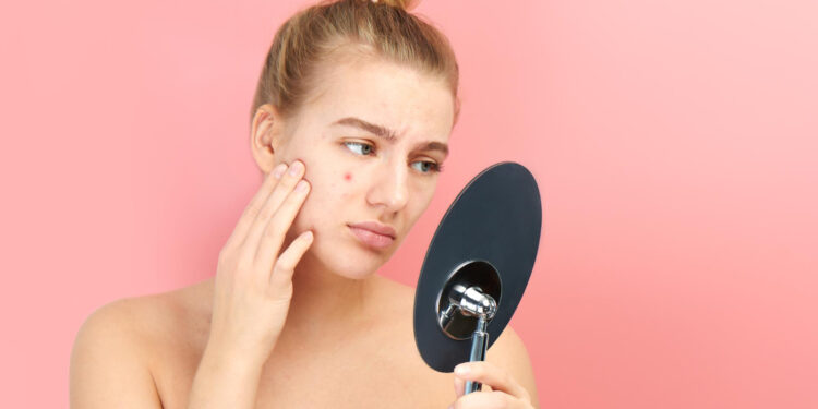 Acne-friendly makeup
