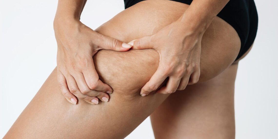 Cellulite: τι ισχύει