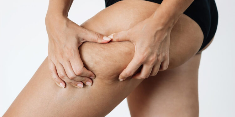 Cellulite: τι ισχύει