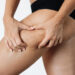 Cellulite: τι ισχύει