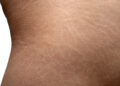 Stretch marks: αντιμετωπίζονται;