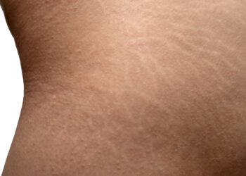 Stretch marks: αντιμετωπίζονται;