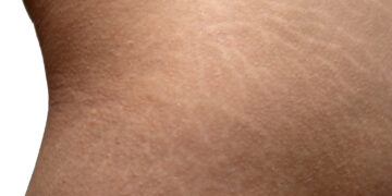 Stretch marks: αντιμετωπίζονται;