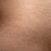 Stretch marks: αντιμετωπίζονται;