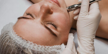 Microneedling: Πώς βοηθά το δέρμα;