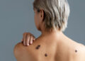 The different types of skin cancer