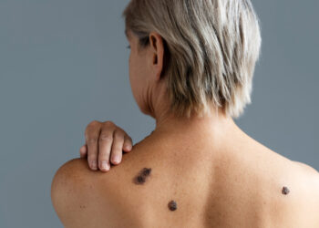 The different types of skin cancer
