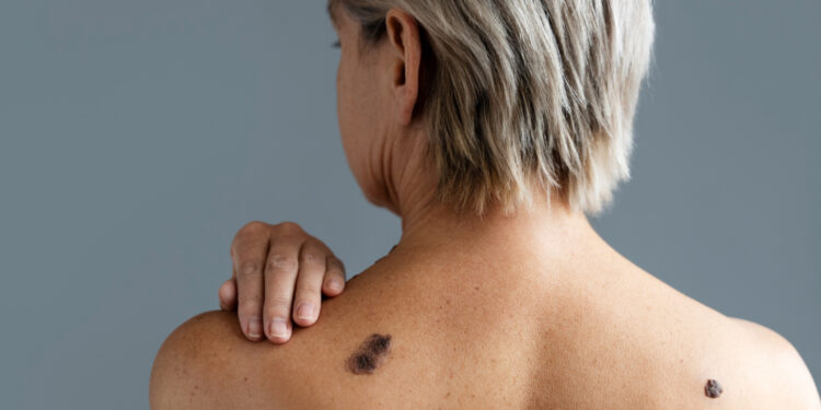 The different types of skin cancer