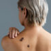 The different types of skin cancer